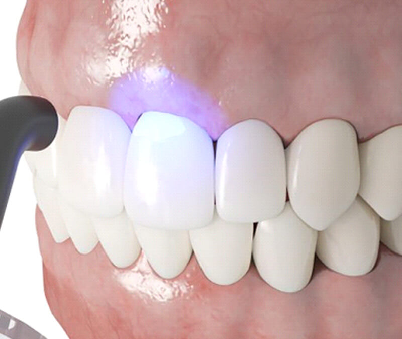Illustration of curing light being used to harden dental bonding