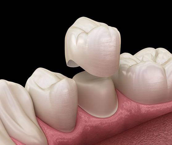 Illustration of dental crown being placed on prepared tooth