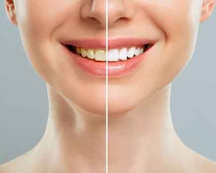 Woman’s smile before and after teeth whitening